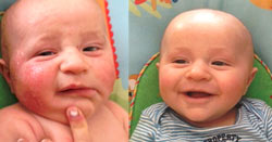 3 month old with severe eczema better with diaper plus