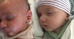 6 Week Old with Eczema - Better in Days