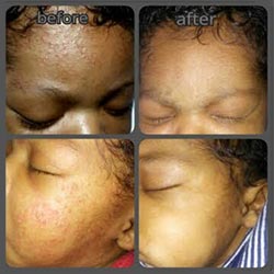 Baby Eczema Much Better in 4-5 Days