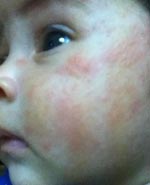 Baby Acne