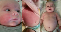 Painful Eczema in 6 Month Old Dramatically Better in One Week