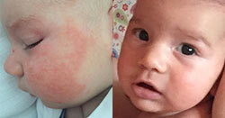 Baby Scratching Eczema Day and Night Better in 1 Week