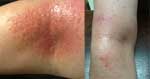 Hot, Itchy Rash in Elbow Clears in Just 5 Days