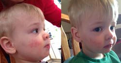 Toddler with 23 Months Facial Eczema Noticeably Better in 3 Days