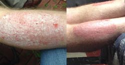 Dry, itchy psoriasis better in 3 days