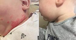 Red Rash on 7 Month Old's Neck Gone