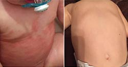 Severe Eczema: Other Creams Made Him Cry. Emily's Brought Relief