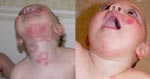 Severe Neck Eczema Due to Teething Much Better in 4 Days